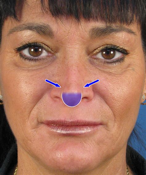 Two holes of our nose. Pinched Nasal Tip & Hanging Columella In Revision Rhinoplasty