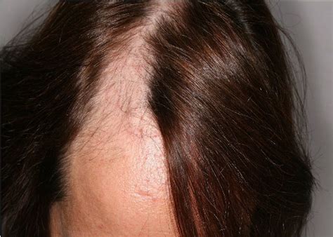 Principales Tipos De Alopecia Femenina Mujer Mujer Con Salud