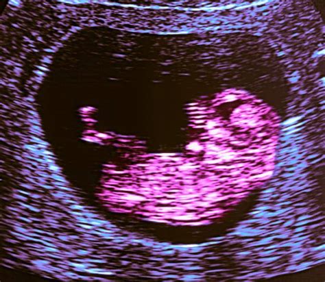 10 Weeks And 3 Days Pregnant Baby Fetal Progress Ultrasound