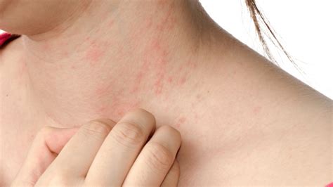 What Are The Different Types Of Skin Rashes University Urgent Care