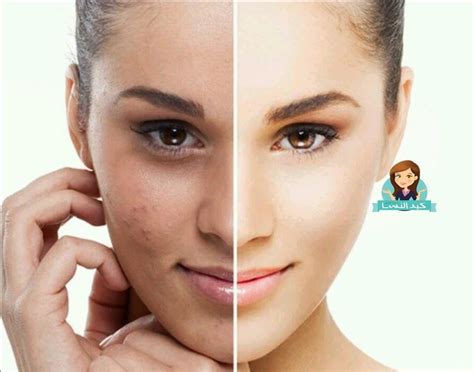 10 وصفات طبيعية لتبييض الوجه وتفتيح البشرة مجلة كيد النسا