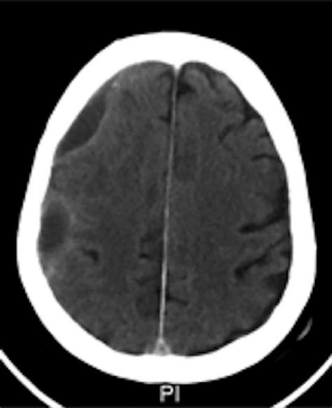 Axial computed tomography head scan with contrast shows 2 subdural ...