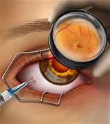 Ocular Histoplasmosis Treatment With Avastin Pictures