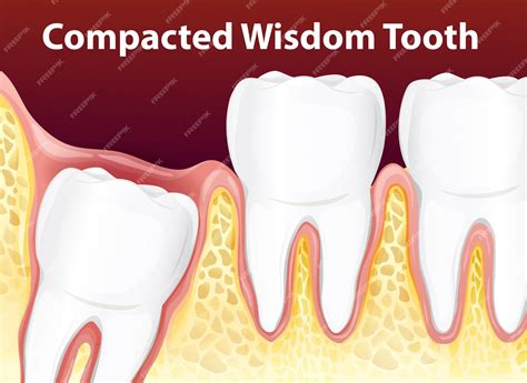 Premium Vector Compacted Wisdom Diagram Tooth