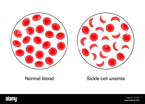 Normal Blood And Sickle Cell Blood Illustration Stock Photo Alamy