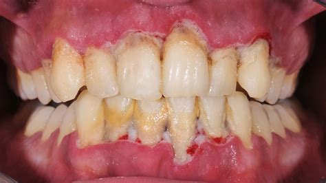 Periodontal Disease And Micronutrients A Clinical Pilot Study Jcm Nh