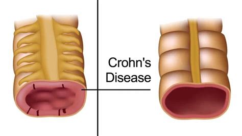 5 Early Warning Signs Of Crohns Disease