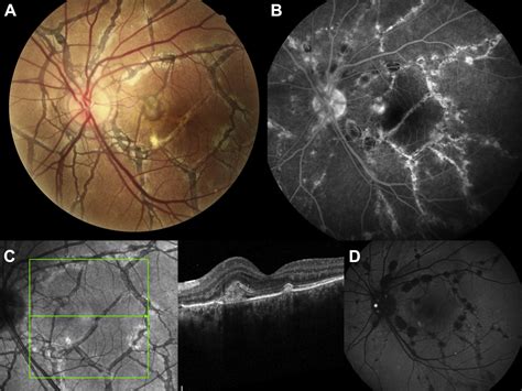 Choroidal Neovascularization Resulting From Angioid Streaks In