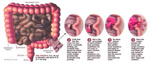 Diagram Colon Cancer Stages Anatomy System Human Body Anatomy
