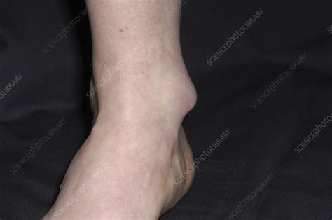 Bursitis Of The Ankle Stock Image M1200200 Science Photo Library