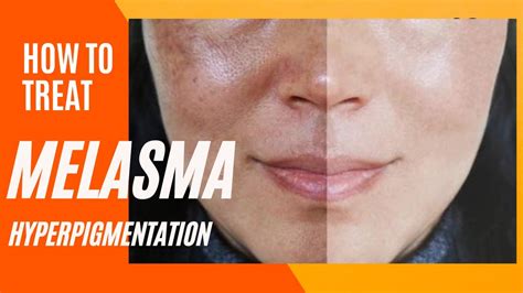 Melasma Removal At Home I Melasma Remove Cream I Melasma Skin Care Regimen Routine Youtube