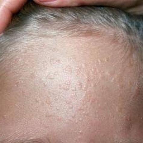 Causes Of Warts On Face