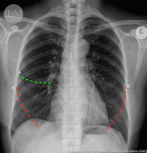 3375 Normal Pa Chest X Ray Fissures 1 Minor A And Maj Flickr