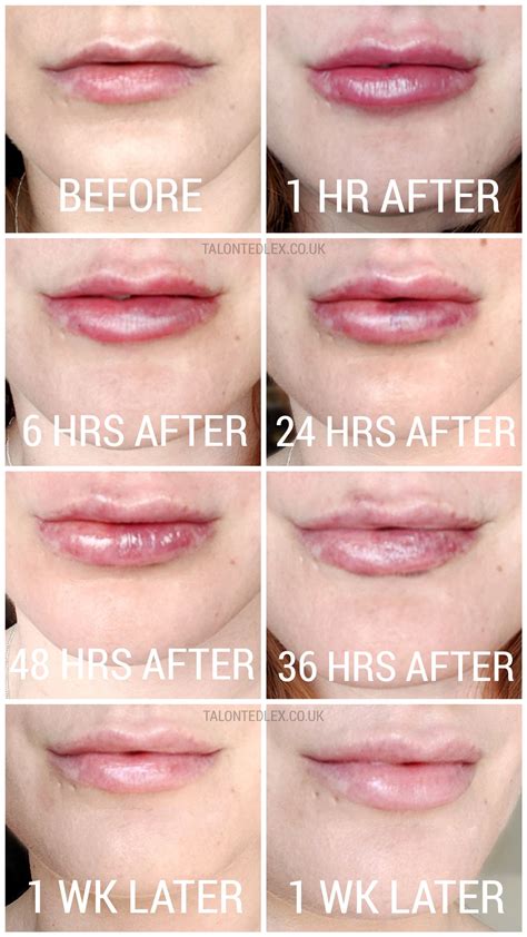 My Lip Fillers Experience With Dr Pamela Benito Talonted Lex