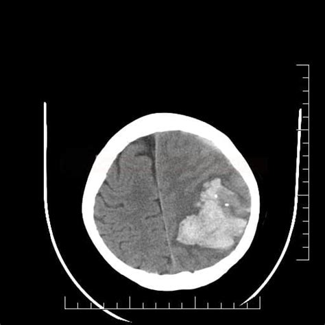 Cerebral Arteriovenous Malformation Avm Stroke Manual