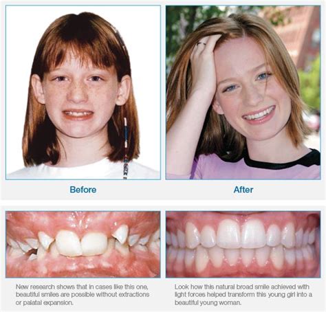 Orthodontic Braces Why Choose Damon Damon System Orthodontics