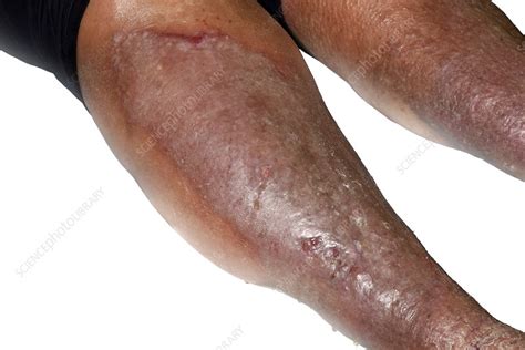 Varicose Eczema Stock Image C0532873 Science Photo Library