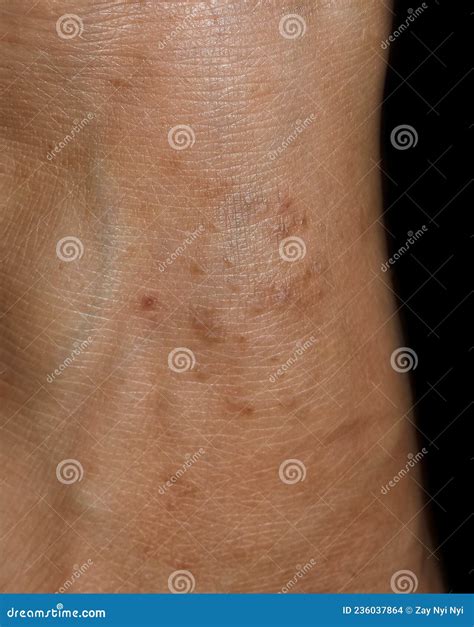 Molluscum Contagiosum Infection In Foot It Is Benign Raised Bumps Or