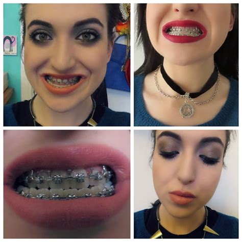 The length of time it takes for braces to correct an underbite varies between patients and is heavily dependent on the severity of the underbite, but patients typically wear the braces for 1 to 3 years or more, as stated by dental associates. My Underbite Experience. (Pre-Surgery)