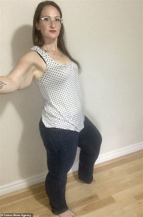 Mother Left Housebound By Her Gigantic Legs Is Trying To Raise £112000