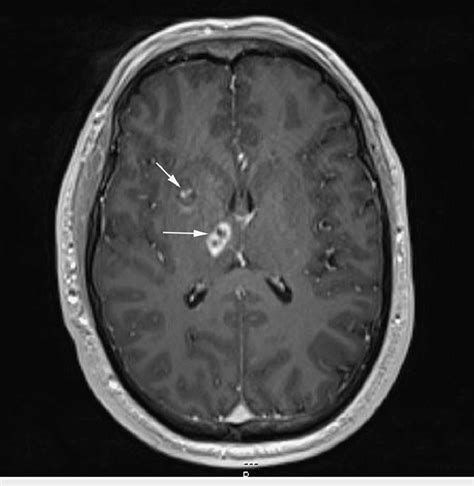 Mri Brain Arrows Show Lesions Of The Right Basal Ganglia And Right