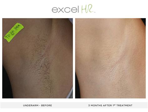 Before And After Laser Hair Removal1 Copy 4 Interlocks Salon