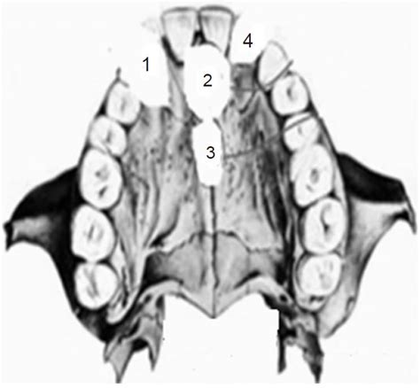 Non Odontogenic Hard Palate Cysts With Special Reference To
