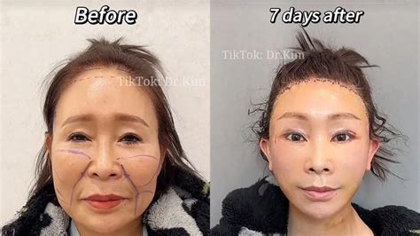 Tiktok Plastic Surgeon Goes Viral For Uncanny Before And After Videos
