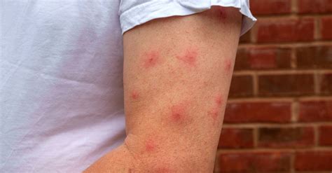 Why Mosquitoes Bite Some People More Than Others Passport Health