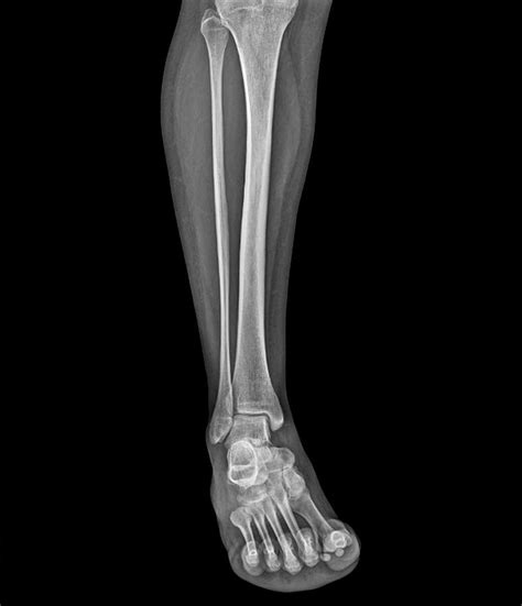 Lower Leg And Foot Photograph By Zephyrscience Photo Library Fine