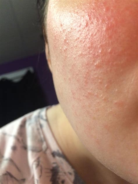 Skin Concerns Bumpy Texture That Wont Go Away Rskincareaddiction