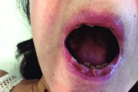 Oral Mucosa Involvement Characterized By Ulcerative Lesions On The