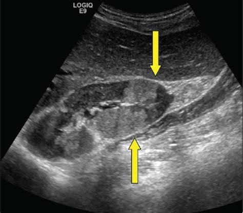 Ultrasound Showing Focal Hyperechoic Tumefactive Lesion Open I