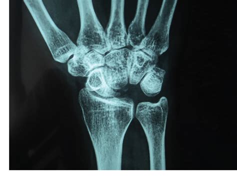 Figure From Aneurysmal Bone Cyst Of Lunate Treated By Excision Without Intercarpal Fusion A