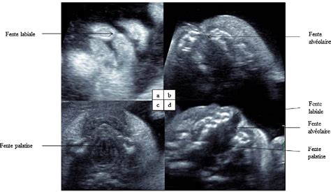 Correlation Between Antenatal Ultrasound And Postnatal Diagnosis In