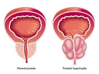 Things You Need To Know About Prostate Cancer Ghone Tv