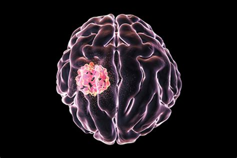 Experimental Vaccine For Brain Cancer Shows Preliminary Evidence Of