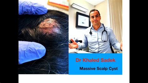 Massive Scalp Cyst Dr Khaled Sadek Youtube