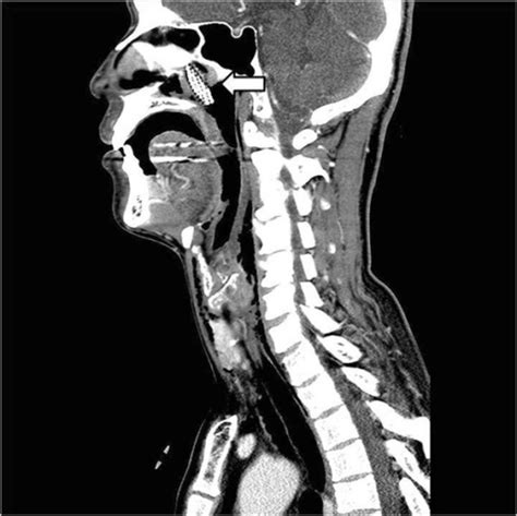 Sagittal View Of Neck Ct Scan Arrow A Neck Ct Shows Open I