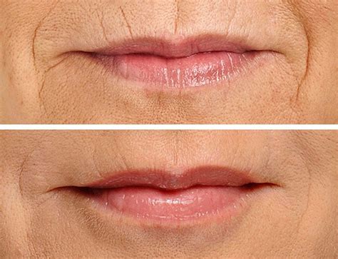 The Best Treatment For Lip Lines Straight From The Doc