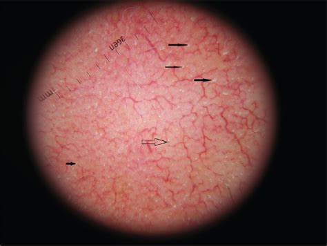 Demodex Folliculorum Associated Bacillus Pumilus In Lesional Areas In