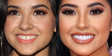 See many photos and videos. Becky G's Teeth Gap Before and After: Pretty Smile and Net Worth
