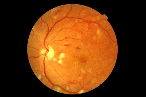 Martyn Kemp Opticians Retinal Screening