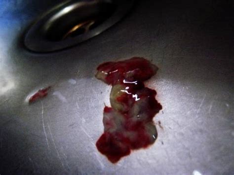 95_bloody-mucus-coughing | Health Recovery Tips