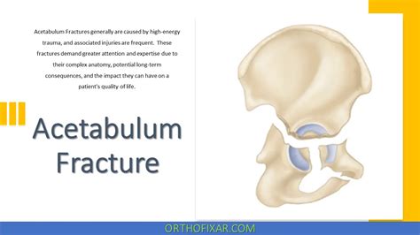 Acetabulum Fracture Full Explained Orthofixar 2024