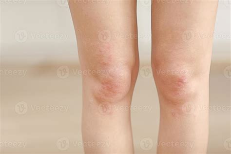 Skin Allergies Legs Skin Women Closeup Of Red Pustules On A Knee An