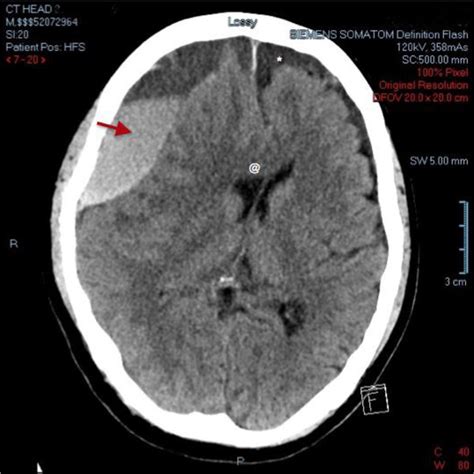 Subdural Hematoma Presenting As Recurrent Syncope Journal Of