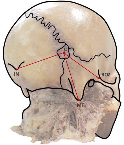 The Distance From The Asterion To Skull Landmarks On The Right Side