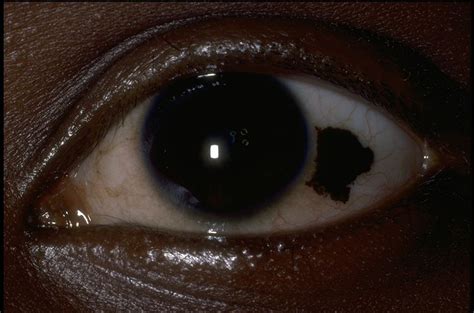 Conjunctival Nevus American Academy Of Ophthalmology