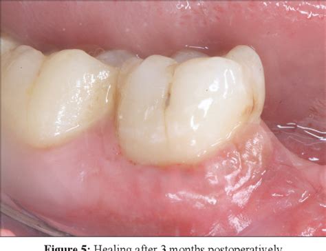Figure 5 From Management Of Gingival Recession In Mandibular Molar